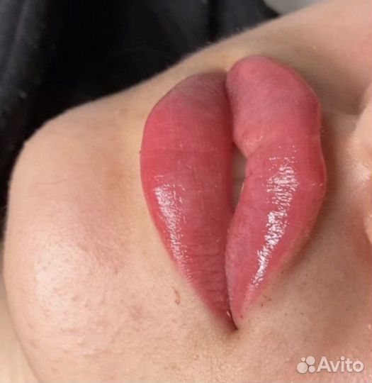 Увеличение губ