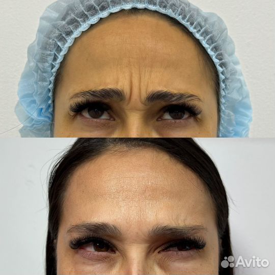 Ботулинотерапия