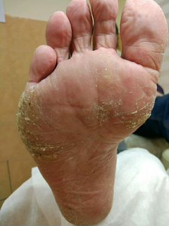 Педикюр медицинский. Подолог